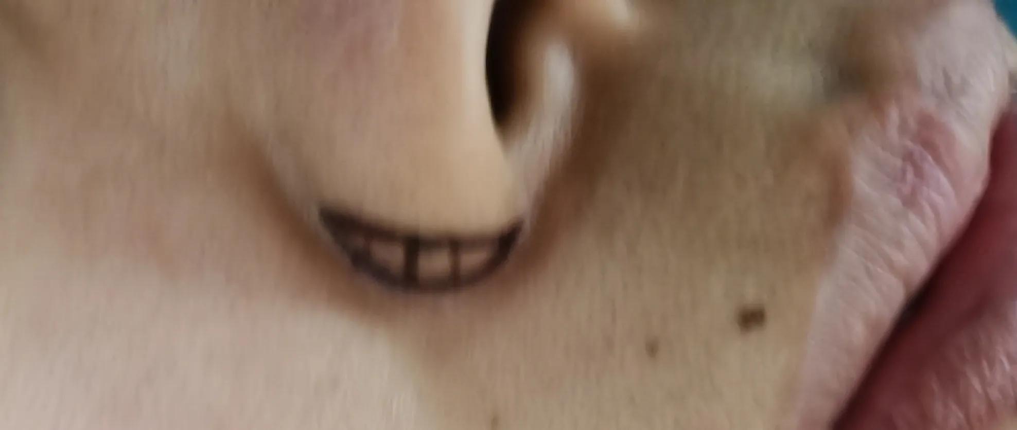 整形医生做面部美容视频,鼻头鼻翼缩小术的真实案例