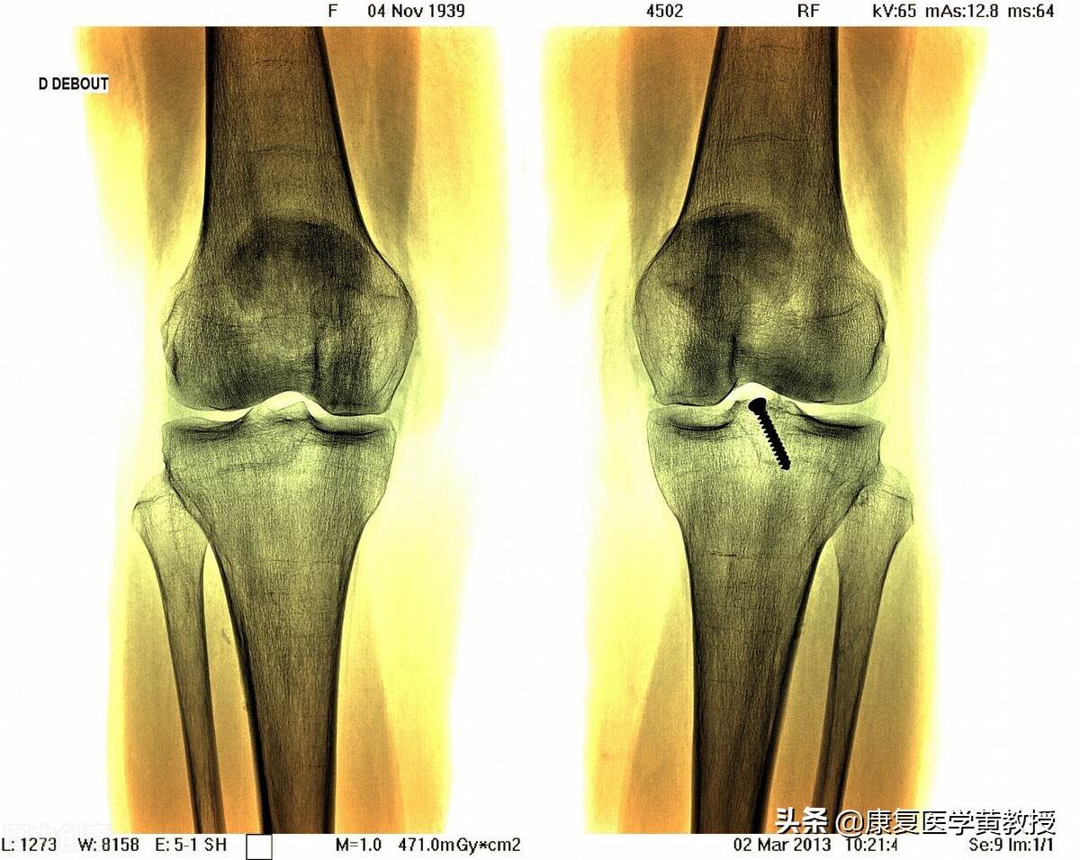 贴膏药为什麽能治疗疼痛，却治不了退行性关节炎？赶紧过来围观