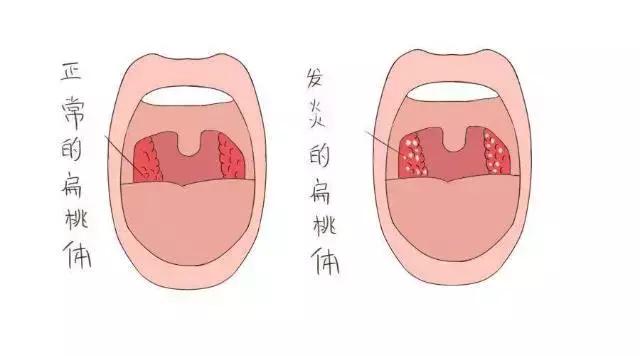 扁桃体总发炎该不该切掉,扁桃体手术要切掉什么结构
