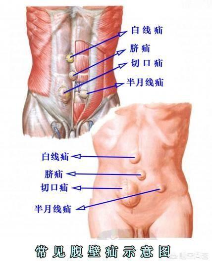 疝气健康科普视频,疝气科普的意义