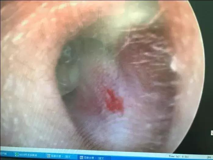 小孩耳朵长肉芽是什么原因引起的,耳朵里长了个肉芽怎么回事