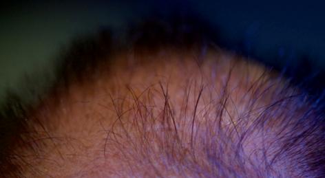 mirna治疗脱发,全球治愈脱发的科学正迅速发展