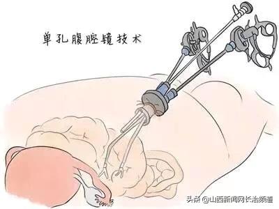 和平医院|肚脐“下刀”不留疤——和平医院开展“经脐单孔腹腔镜手术”