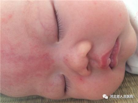 盘点新生儿特有的体征“符号”