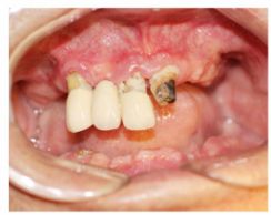 满口缺牙如何补牙,满口缺牙怎么办