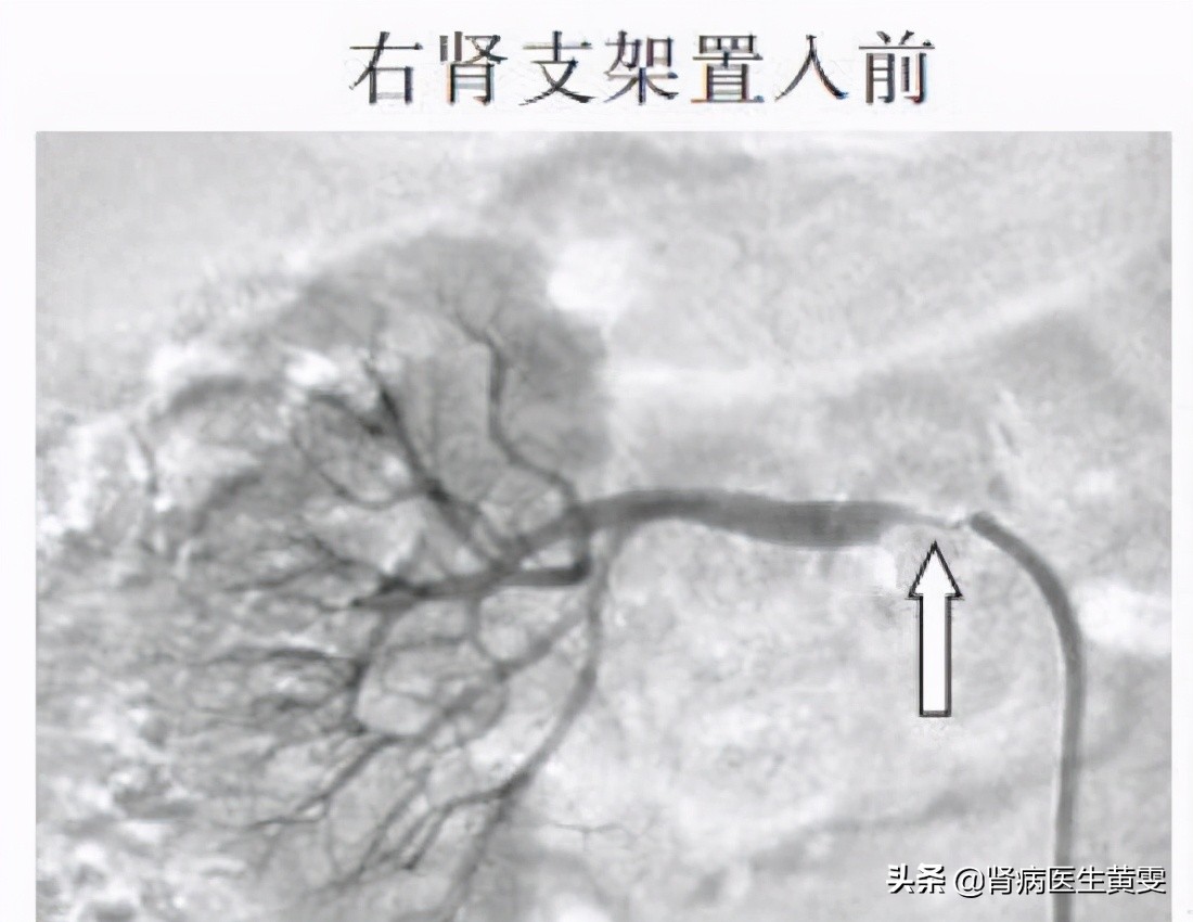 肾动脉硬化引起肌酐升高能治好吗,肾积水肌酐偏高怎么调理