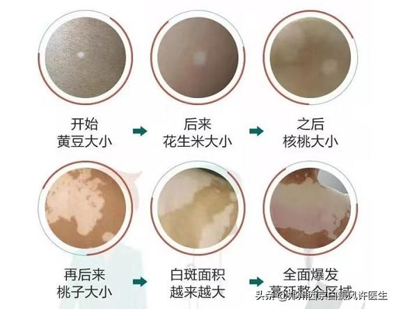 白癜风一直在发展该怎么控制住,白癜风一直半边脸上扩散