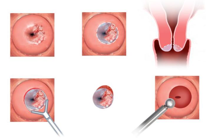 宫颈癌疫苗免费视频,关于宫颈癌疫苗的各种答疑