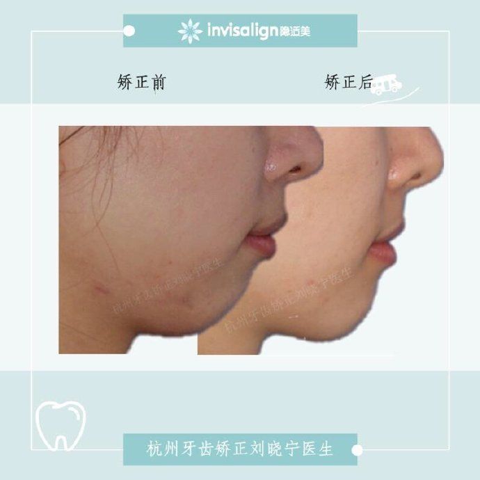 矫正牙齿如何改善露龈笑,矫正牙齿可以改善露龈笑吗