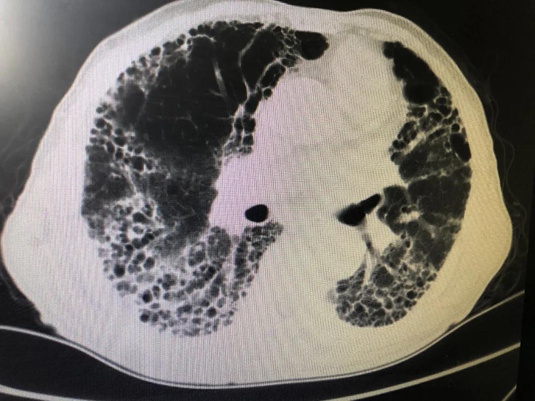 辽阳三院成功救治特发性肺间质纤维化急性加重高龄患者