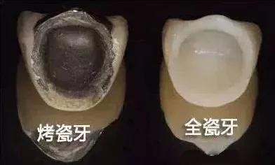 口腔假牙以旧换新活动,镶牙活动假牙