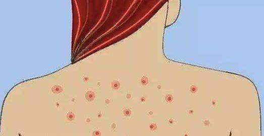 背后有痘痘夏天不敢穿露背的吊带,后背有痘印穿露背装的小技巧