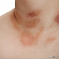 皮肤干燥脱皮10分钟清晨急救法,皮肤干燥尤其是秋冬会全身脱皮