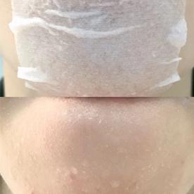 这6种办法能助你快速去闭口,去闭口最简单的消除方法