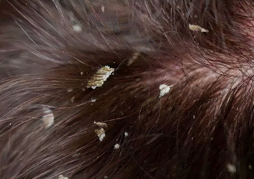 头皮屑严重如何处理好得快,头皮屑多是什么原因到底该怎么治