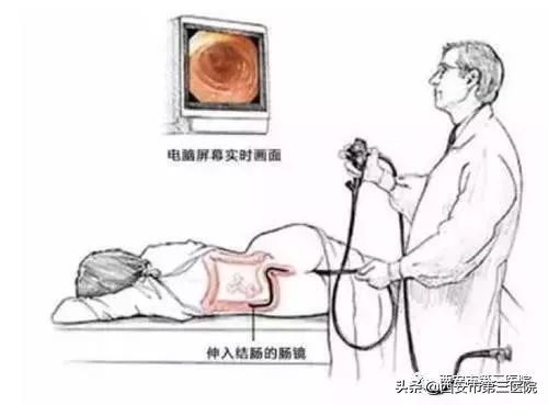 专家医生讲胆囊息肉,息肉是否越切长得越快