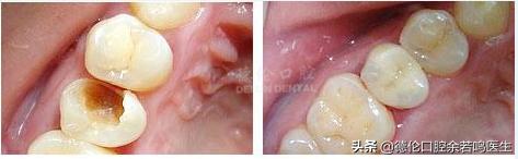 现在修复牙齿有哪几种类型的牙,牙齿修复的几种方法和价格