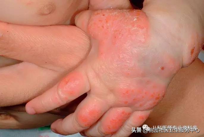 儿童湿疹和痱子要分清楚,成人痱子和湿疹如何分别