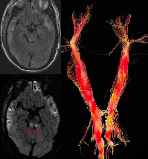 磁共振成像mri的基本原理,磁共振后dti怎么处理