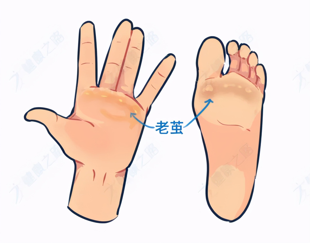 脚底长了鸡眼该怎么正确处理,脚底长鸡眼太深怎么挖出来