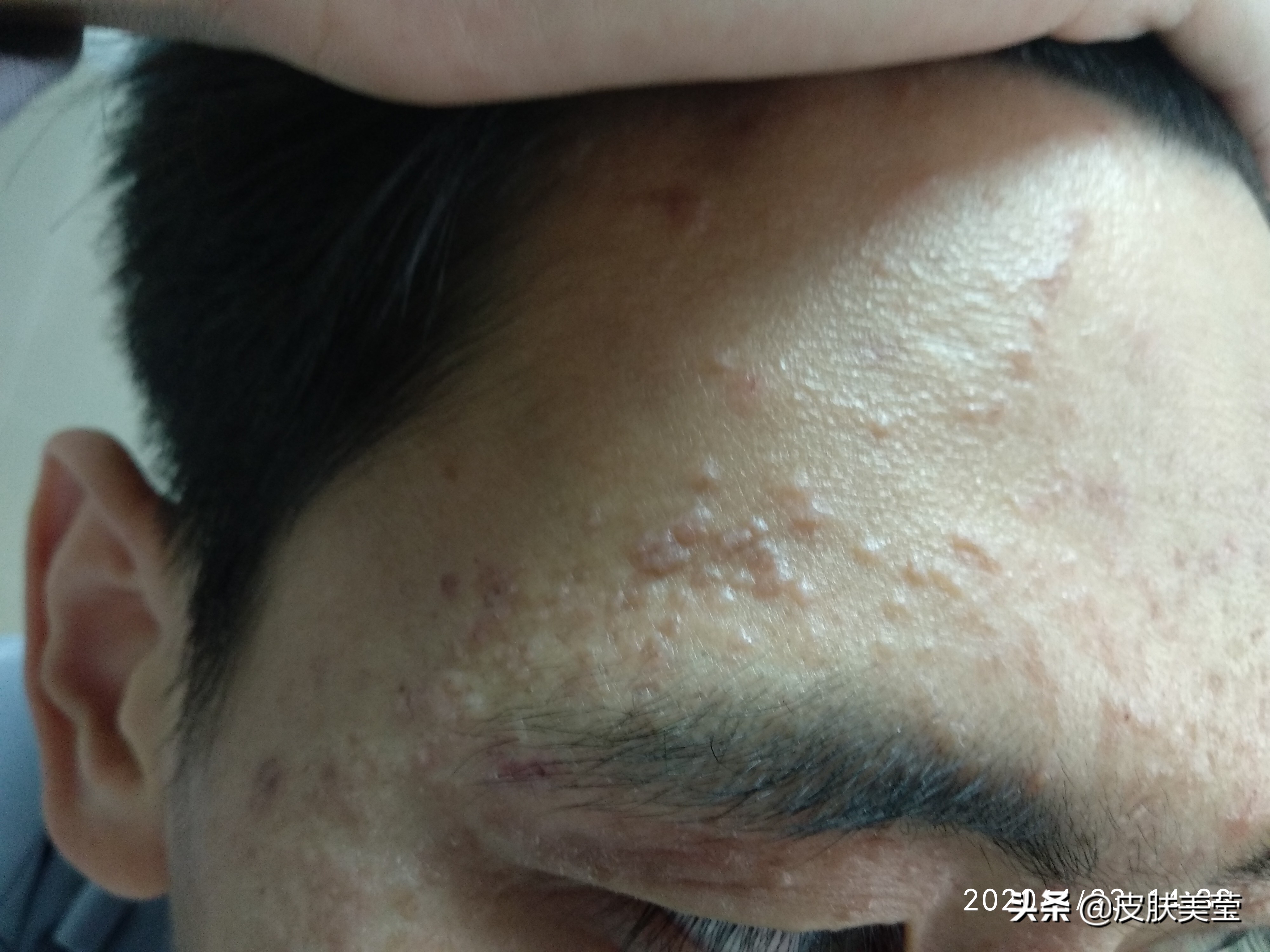 接种hpv疫苗可以预防其他癌症吗,hpv疫苗会让人感染hpv病毒吗