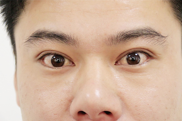 乙肝身体恶化吃什么药,乙肝恶化面部红斑点