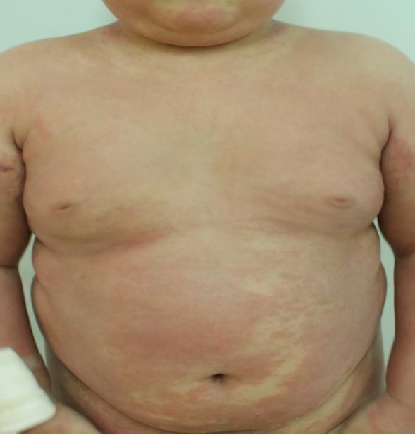 女儿得了银屑病怎么办,宝宝湿疹和银屑病区别