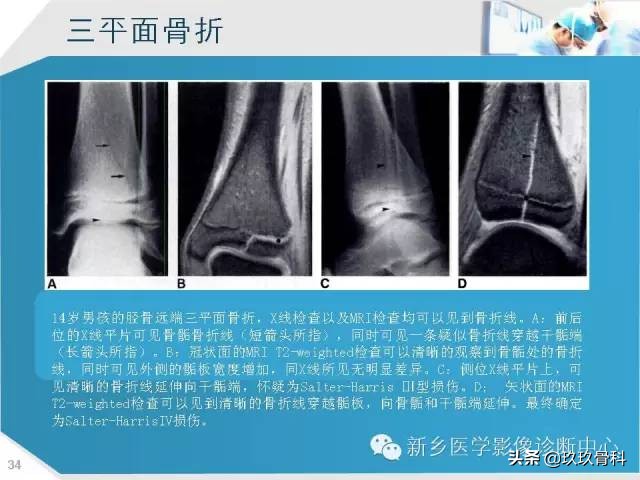 骨骺损伤x线表现,骨骺损伤磁共振表现