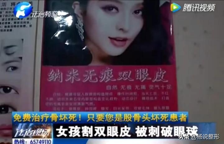 整形医生科普割双眼皮必看攻略,割双眼皮一定好看吗