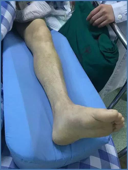 扭伤拉伤处置,扭伤拉伤治疗手法