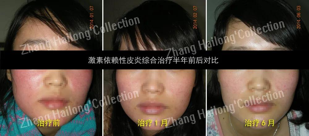 激素依赖性皮炎饮食注意事项,激素依赖性皮炎用什么护肤品