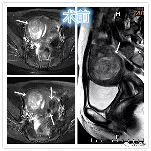 子宫肌瘤不能开刀只能化疗严重吗,子宫肌瘤介入栓塞治疗后注意事项