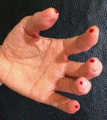 刺血疗法后的注意事项,刺血疗法注意事项及禁忌