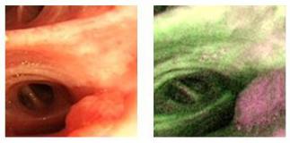 孙加源门诊,治疗肺癌的新技术新手段