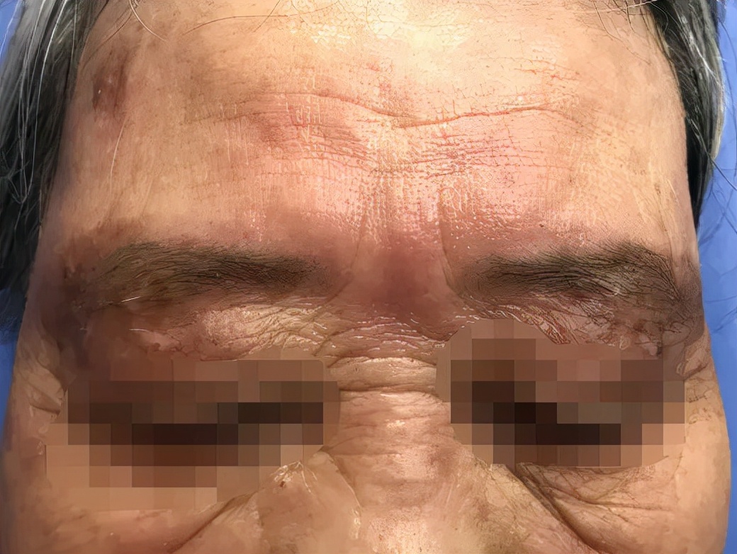 白癜风的正确看法,突然间长白癜风怎么回事