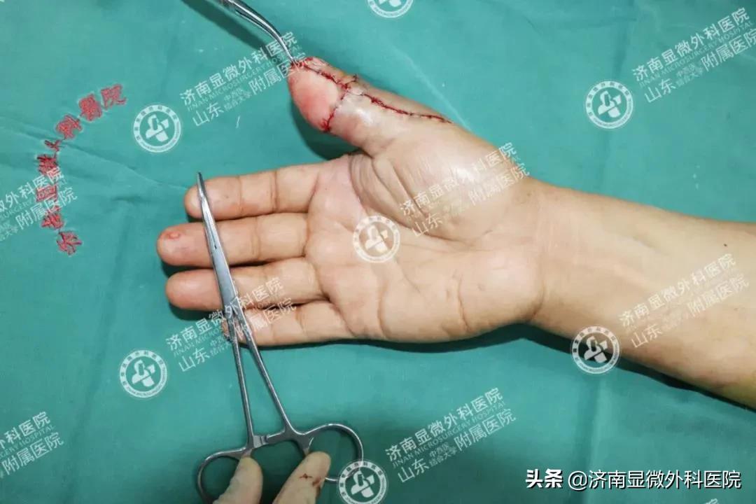 注意！失去一截手指不要灰心，这样做能重新复原它