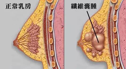 乳腺囊肿的表现和症状,乳腺囊肿正确的理解