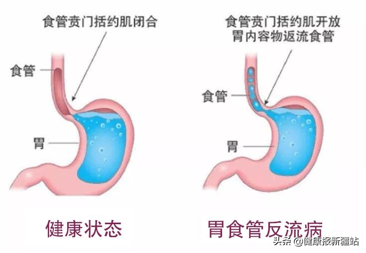 内镜下治疗胃食管反流手术怎么样,自治区人民医院做腹腔镜手术