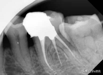 根管治疗断针算不良事件吗,根管治疗断针属于医疗事故吗