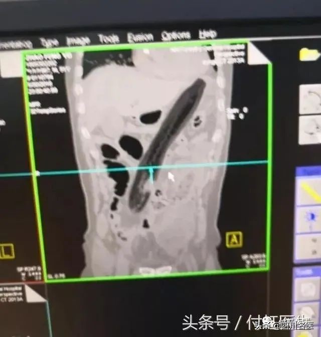 一条罗非鱼“游”进肛门？医生：直肠不直，进去容易出来难