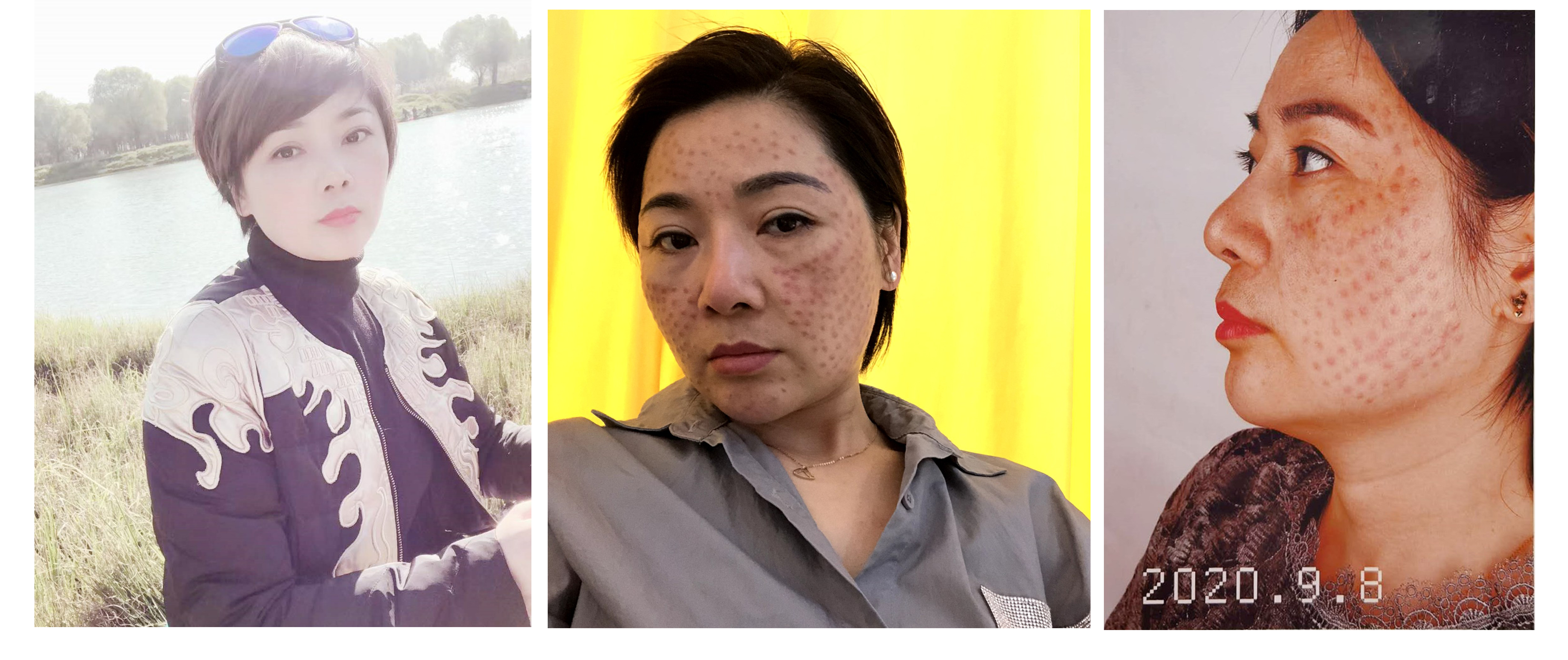 女子注射6针玻尿酸致残案例,女子打水光针致残