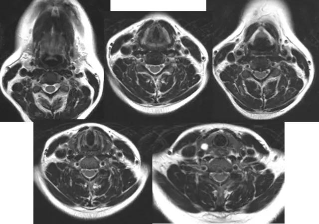喉部病变做核磁还是ct,耳鼻喉科常见病影像诊断