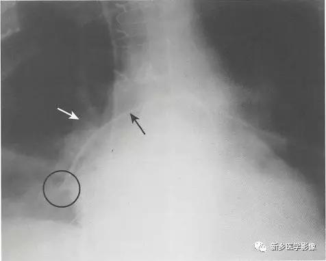 动脉导管未闭胸片表现是什么,血管cta和造影狭窄程度判断