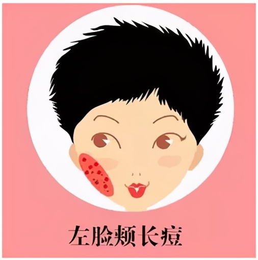 不同部位长痘痘的原因和改善方法,不同部位长痘痘的原因和应对方法