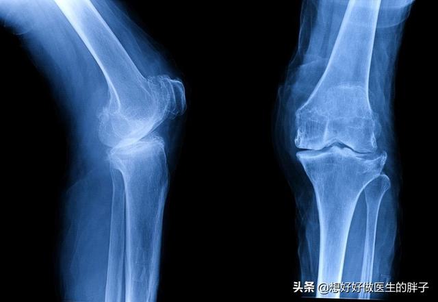 这几招防治膝骨关节炎有效,女性如何预防膝骨关节炎