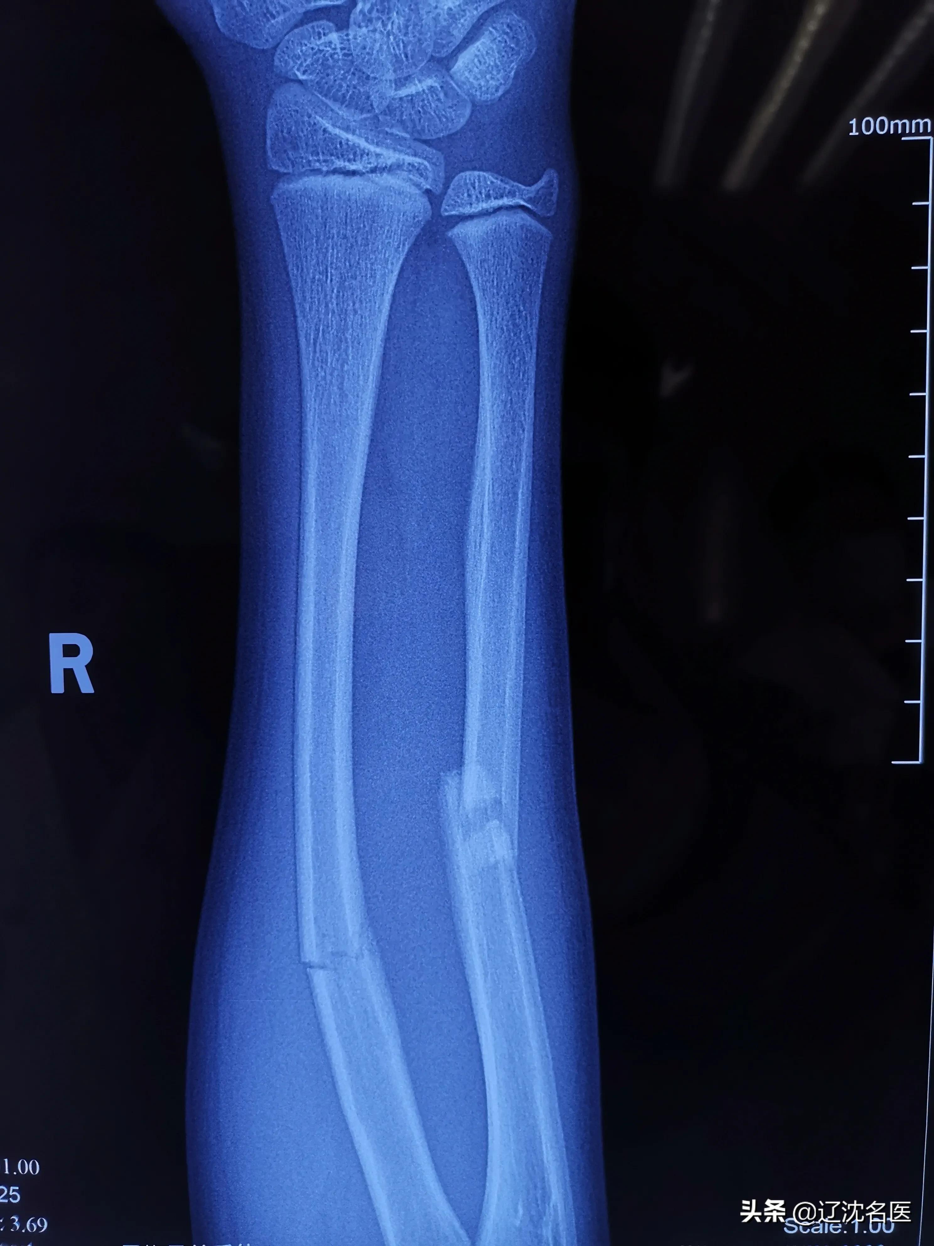 儿童尺桡骨双骨折保守治疗后错位,六岁儿童桡骨颈骨骨折多久恢复