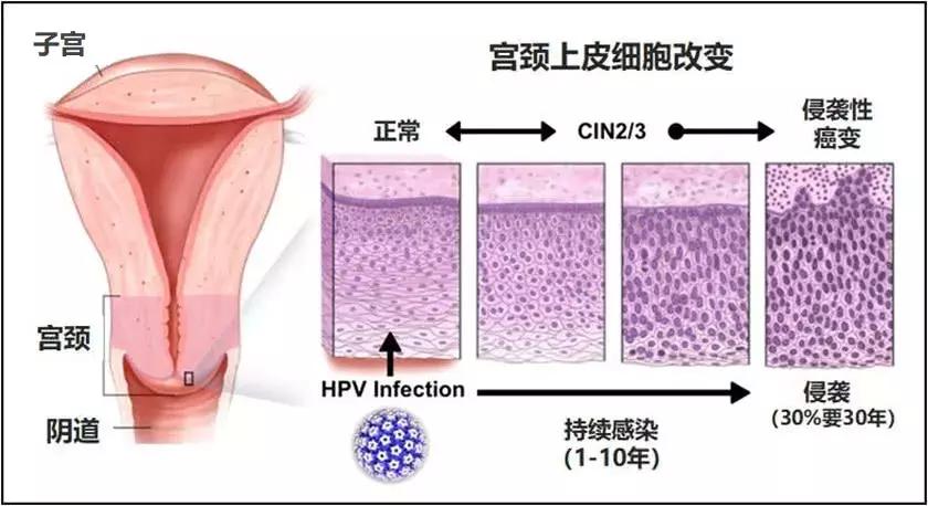 宫颈癌应该注意的几个地方,宫颈癌是不检点得的吗
