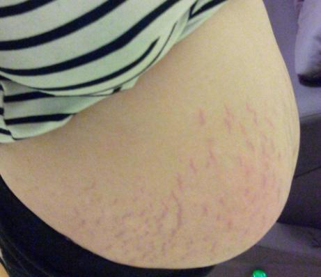 擦油真的能预防妊娠纹吗,教你如何正确擦油防止妊娠纹