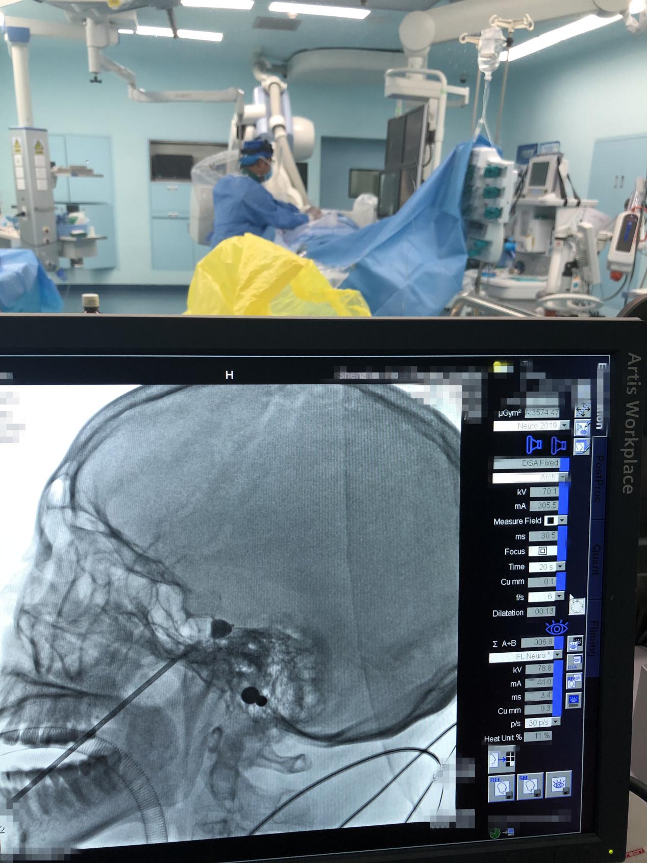 别再让牙齿做替罪羔羊，微创球囊拯救三叉神经痛