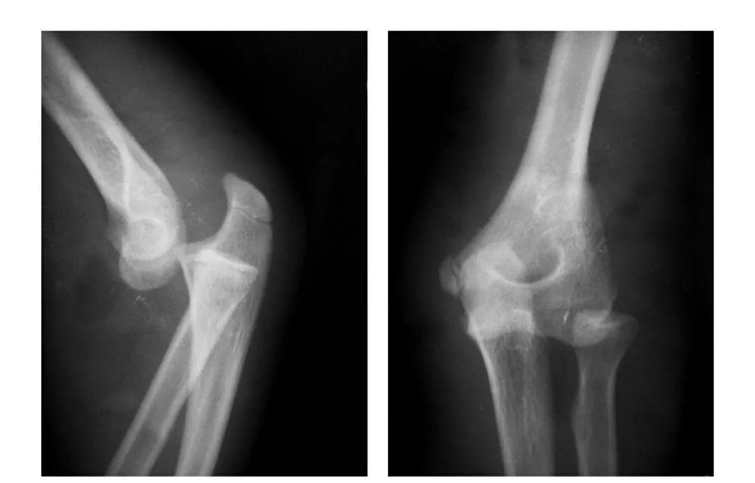 青少年肘部损伤最常见的是,肘部桡神经损伤的临床表现
